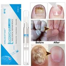 Анти-инфекция Paronychia 12,5 см x 1 см лечение грибковых ногтей Уход за ногами эссенция для ногтей Отбеливание ног гель для удаления грибка ногтей
