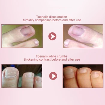 

NEW Nail Foot Protector Skin Care Cream Fungus Treatment Herb Nails Repair Liquid