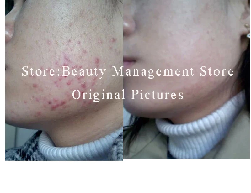 20% peeling com ácido salicílico ácido creme
