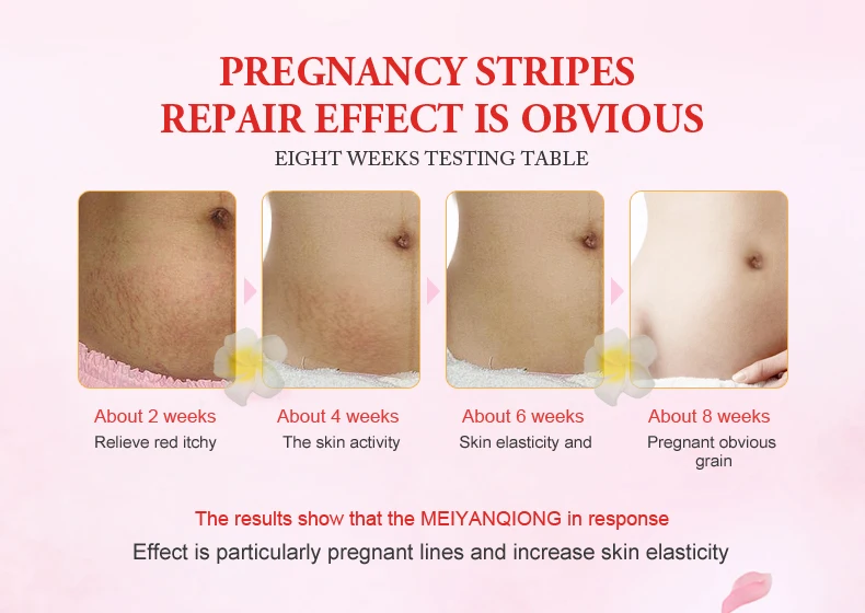 MeiYanQiong драгоценный крем для тела для кожи, средство для удаления растяжек и шрамов, мощный крем для лица после родового ожирения и беременности