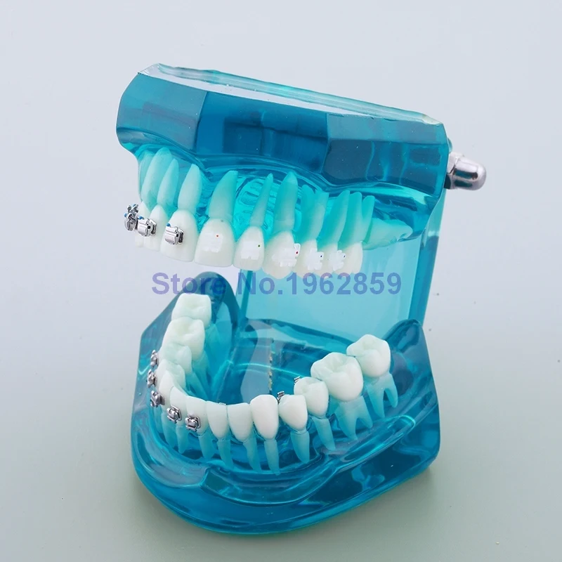 

Teeth Model Orthodontic 4-type Brackets Contrast Metal Ceramic Lingual Invisalign Braces Dental Orthodontic Model