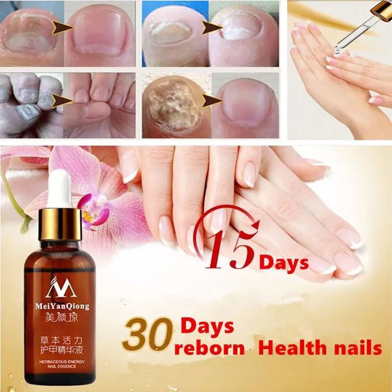 30ml Chinese Medicine Toe Nail Fungus Treatment Anti Fungal Nail Infection Essence Removal Nail Care Lotion TSLM2