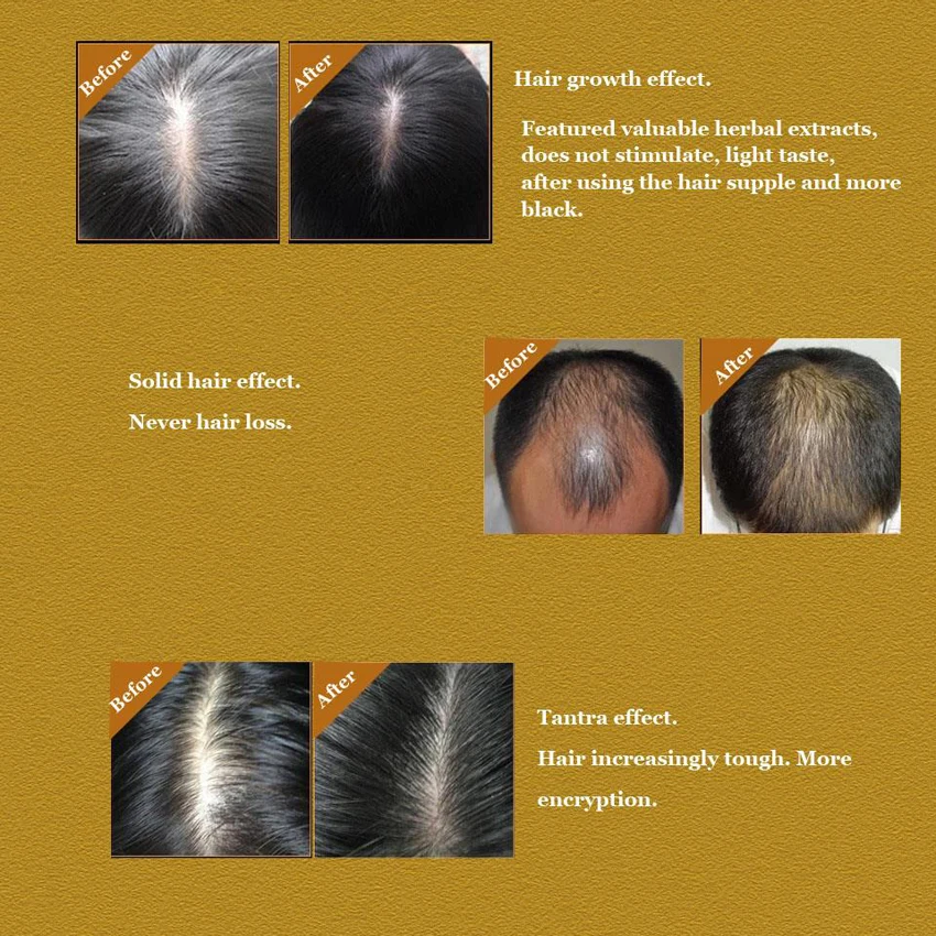 Тоник для волос для выпадения волос средства быстрого ухода средства для роста волос для женщины мужчины, ребровь волос, yuda pilatory Лечение 2 бутылки