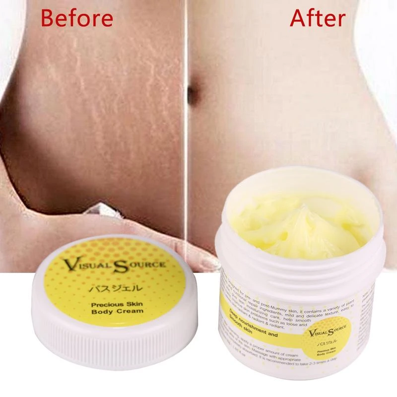 cream for removal of stretch marks