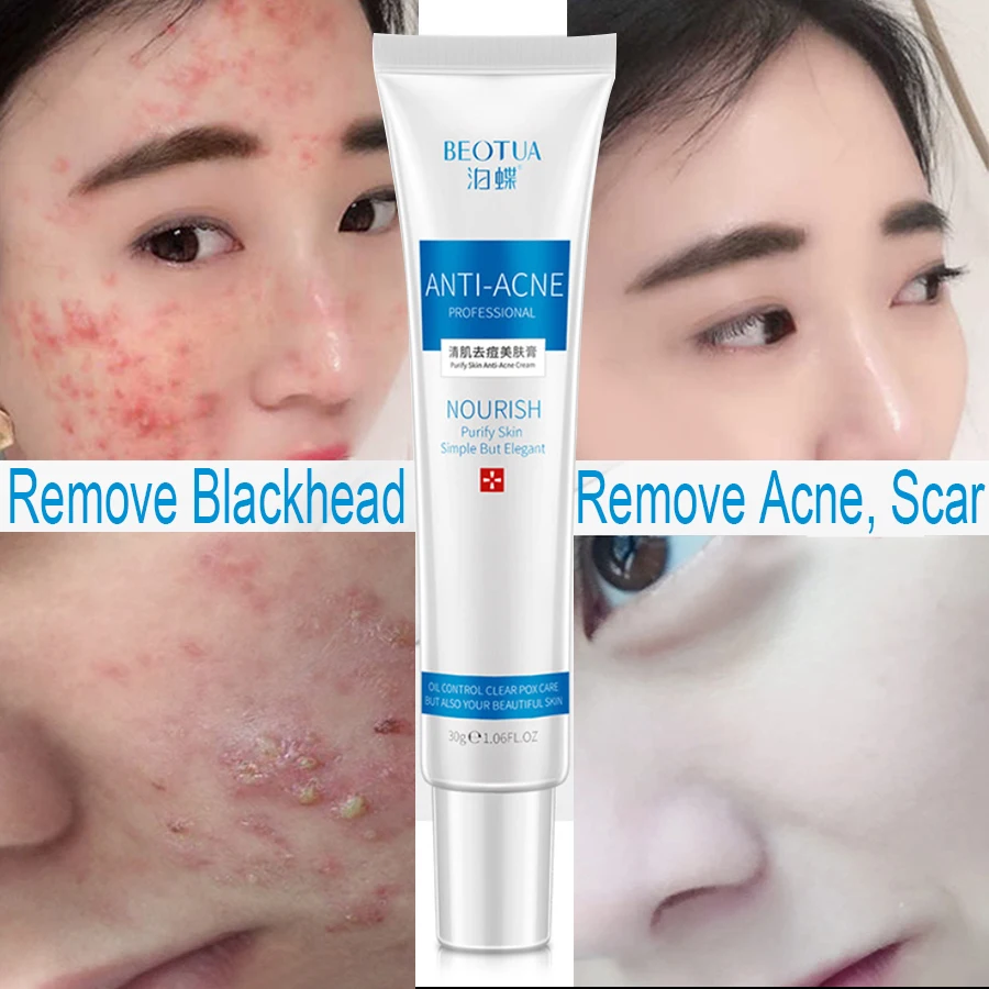 

MayCreate 30g Anti Acne Cream Face Blackhead Acne Scar Removal Cream Oil Control Shrink Pores Treatment Serum Whitening Cream