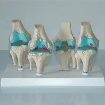 

knee Lesions arthritis model human skeleton model knee osteoarthritis disease model knee joint model