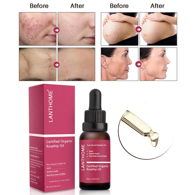 

10ml Effective Organic Rose Essential Oil for Scars Fine Line Wrinkle Stretch Marks