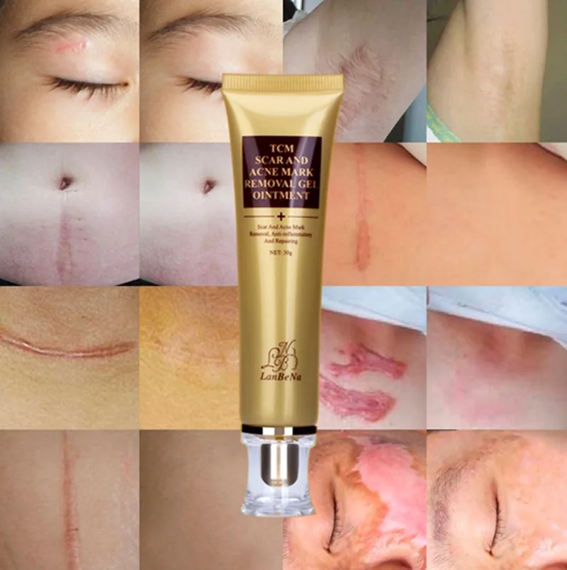 2017 New Style LANBENA Acne Scar Removal Cream Skin Repair Face Cream Acne Treatment Blackhead Whitening Cream Stretch Marks 30m d
