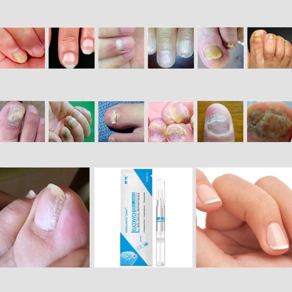 Уход за ногтями, Лечение грибка, масло для удаления онихомикоза, паранихиа, против грибковой инфекции ногтей, traitement des mycoses des ongles