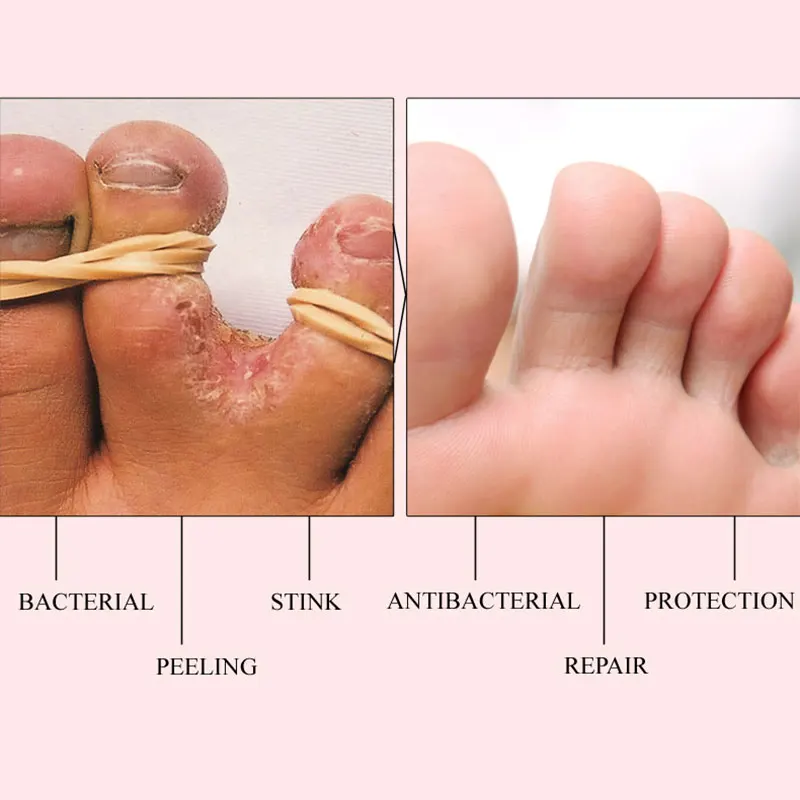 Травяное лечение ног против грибковой инфекции onychomicosis Paronychia эффективное лечение грибка ног Крем для ремонта ног care5