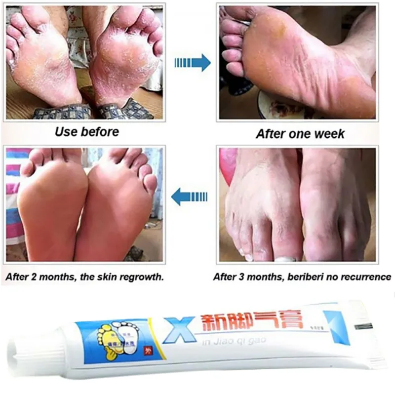 Foot Care Cream Foot Odor Treatment Feet Care Smelly Itching Ointment Chinese Medicine Feet Care Cream