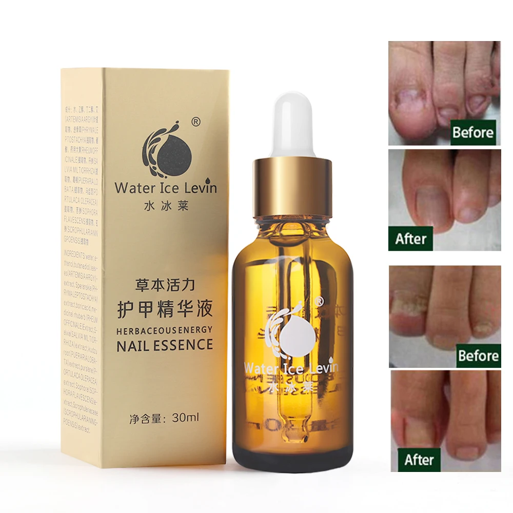 30ml Finger Toe Repair Essence Bad Nail Removal nail Care Oil Feet Nail Care Beauty Manicure Tools