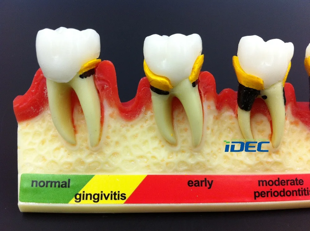 Стоматологическая модель зубов пародонтальная болезнь Assort зуб классификация модель 1 шт