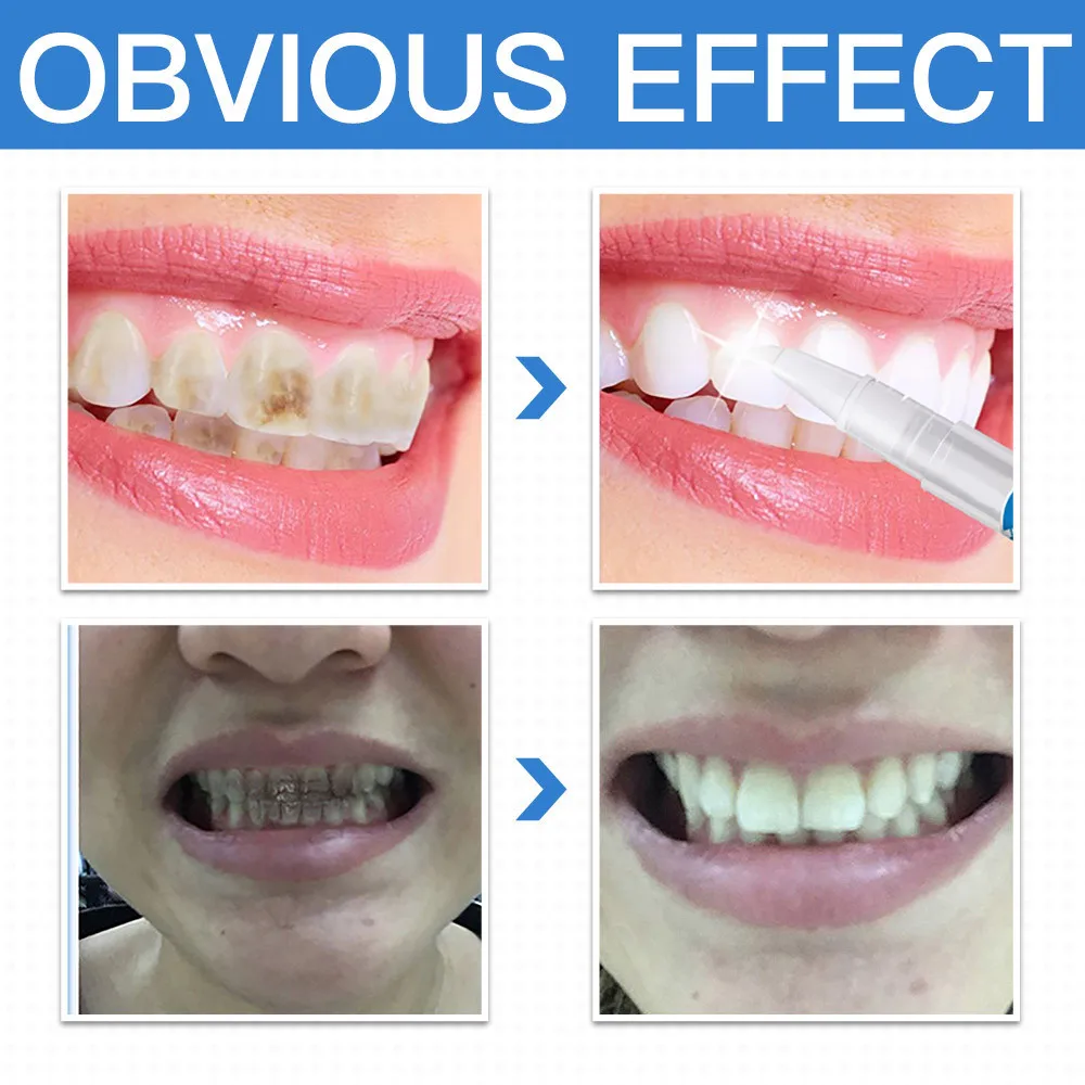 Отбеливающая гелевая ручка для зубов быстрая удаление пятен желтая отбеливающая белая ручка