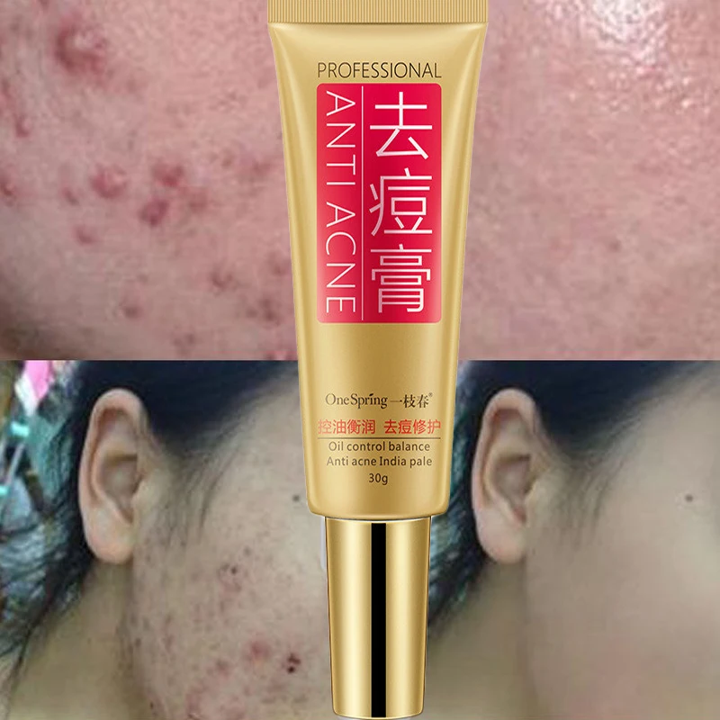 BIOAQUA Acne Treatment крем для лица отбеливающий уход за кожей черная голова удаляет