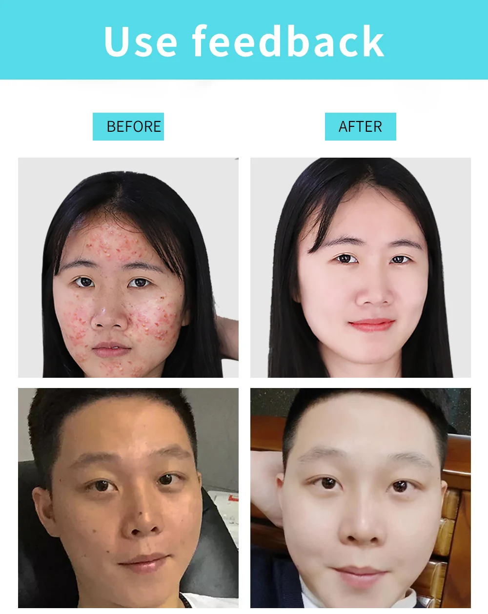 acne tratamento remover cravo diário rosto lavagem cuidados com a pele