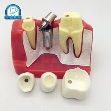 Модель зуба обучающая 4X зубная посадка поясняющая модель имплантаты ногтей