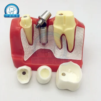 

Dental Teaching Model 4X Tooth Planting Explanation Model Implant Nails