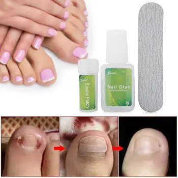 

Nail Tools Ingrown Toenails Physical Correcting Elastic Patches Pedicure Tool Kit Correction Set Nails Accessoires