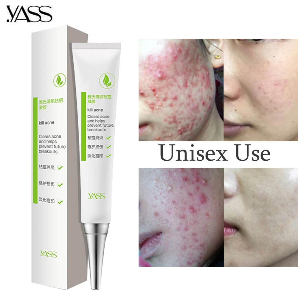 Herbal Acne Cream Anti Pimple Spot Acne Scars Blackhead Removal Cream Whitening Beauty Skin Face Care Creams Acne Treament