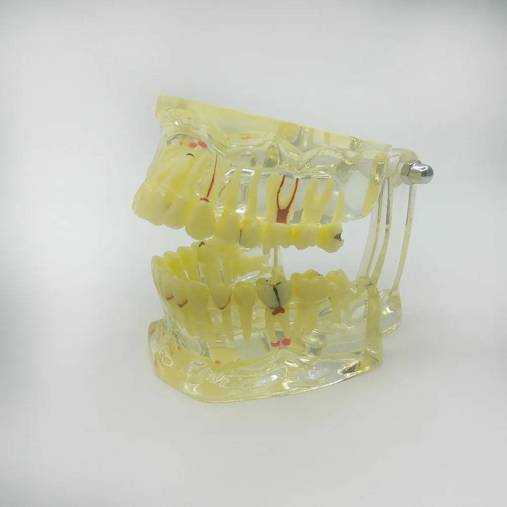 Dental materials denture model Oral unremovable dental pathological