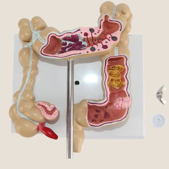 Lehrmodell Der Medizinischen Menschlichen Modell Von Colon Pathologischen Modell Rektum Anhangen Medizinische Lehrmodell Colon Aliexpress