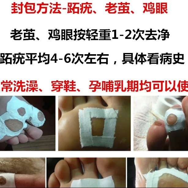 foot pomada the treatment on plantar machine States USD Natural verruga United Chinese Dollar bump gel Stop118 finger Last warts for or the removal discount warts de or 4 foot pomada the treatment 4