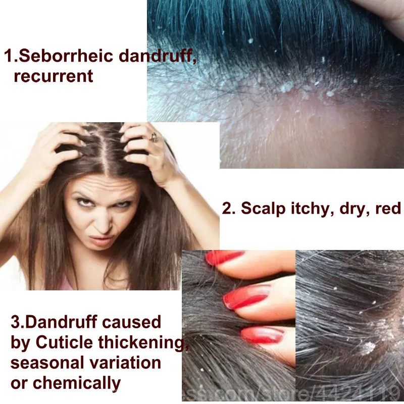 

HOT Shampoo Hair Care Anti Dandruff Strong Antipruritic Hair Treatment Hair Products Dermatitis Hair Dandruff Repair Health care