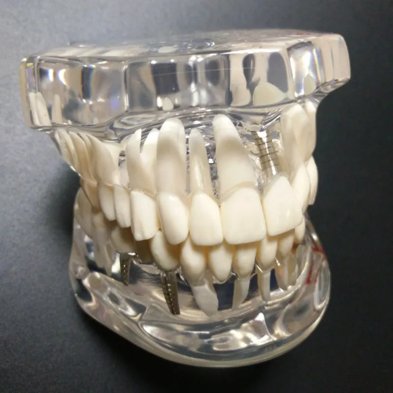 Modelo de caries para implante dentário transparente,