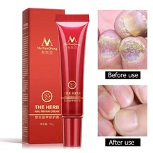 Травяной гриб для лечения Ногтей, защита для ног Onychomycosis Paronychia, против грибка для ногтей, крем для восстановления ногтей, крем для ухода за кожей