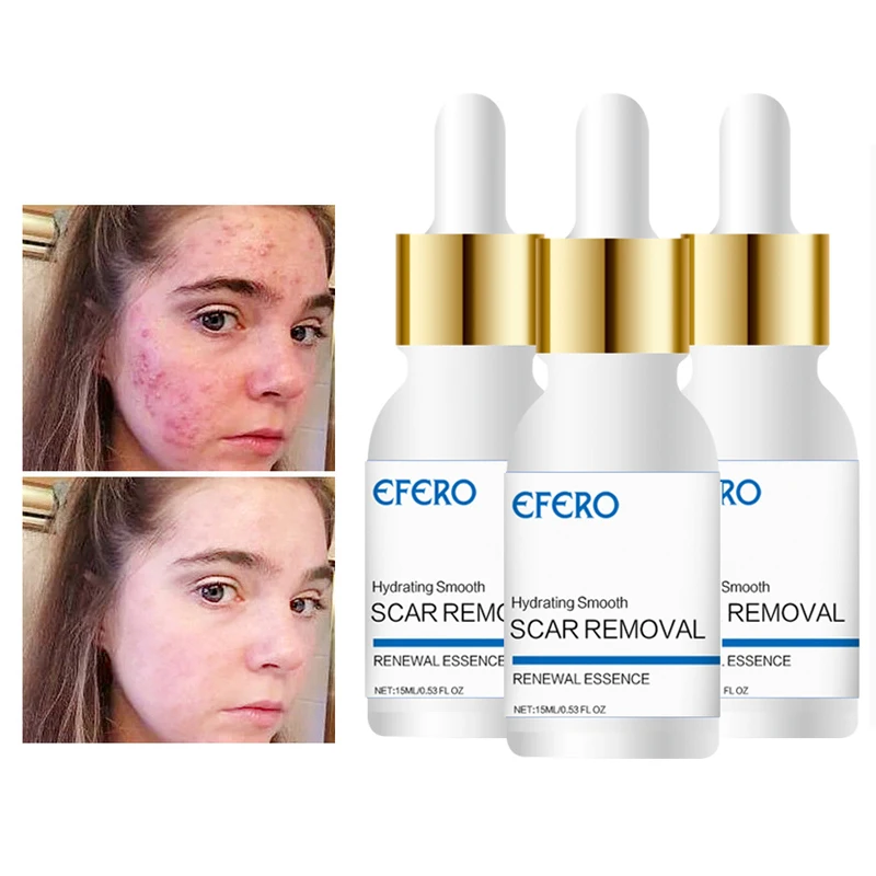 Buy Acne Lighten Essence Moisturizing Face Serum Oil