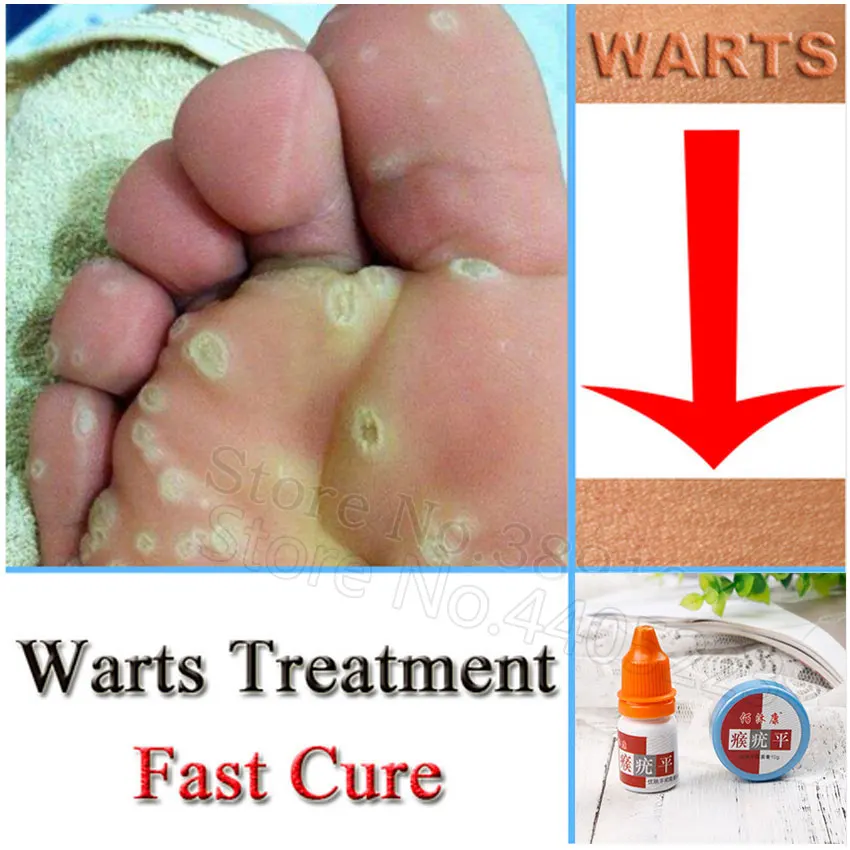 Wart treatment toe