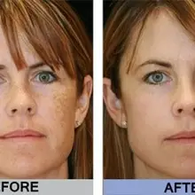 2 унций молочно-Кислотный пилинг для кожи-50%-для: акне, шрамов, морщин, меласмы, возрастных пятен