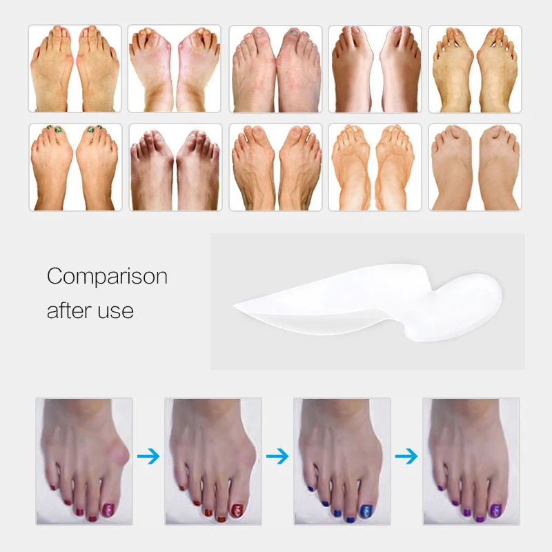 4pcs=2pair Silicone Bunion Corrector Bone Big Toe Protector Orthotic Gel Foot Care Tool Hallux Valgus Toe Spreader Pedicure Tool
