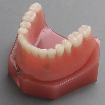 

Human Dental lab denture teeth anatomy Overdenture Inferior with 2 Implant Demo Model Demonstration Teeth Model pathology Model