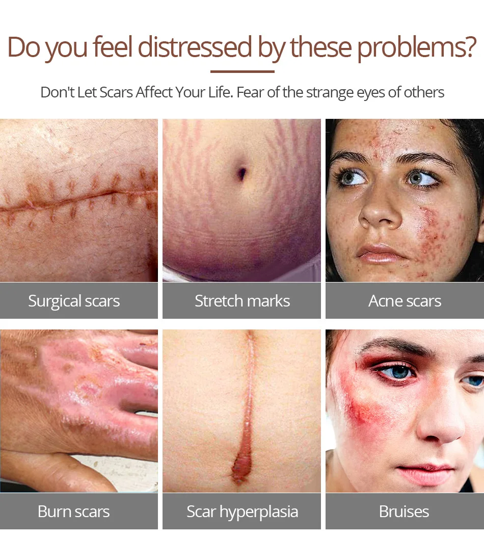 crocodile oil for stretch marks