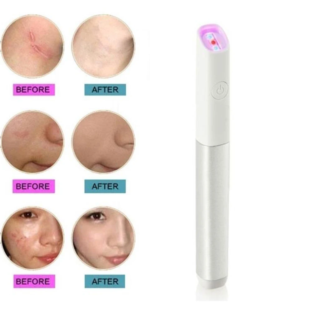 

1 Pc Red Light Blue Light Electric Handy Anti-Inflammation Acne Removal Pen for Women