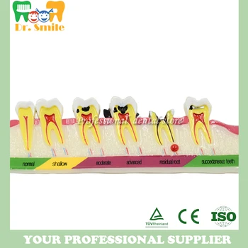 

Dental Caries Developing illusteation Tooth Model Demonstration Teach Patient