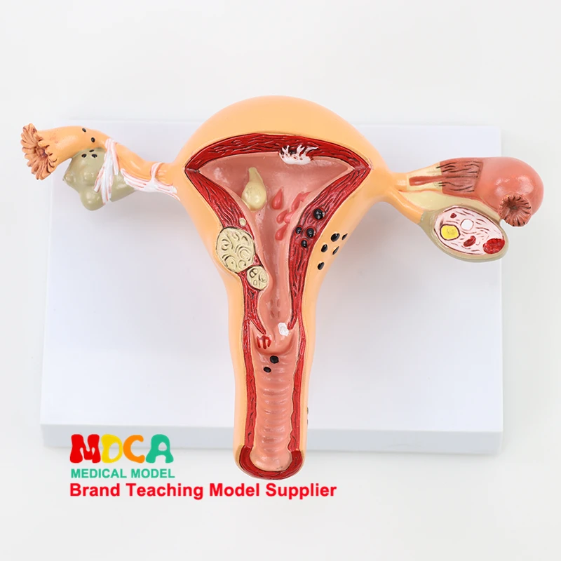 Медицинское обучение патологической матки модель репродуктивной системы для планирования семьи матка половая анатомическая модель MSZXT001