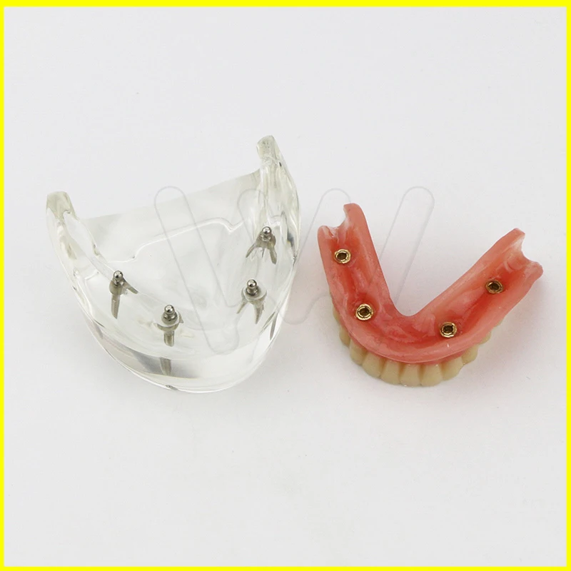1 шт. Стоматологическая модель исследования зубов Overdenture уст 4 имплантата демонстрационная модель