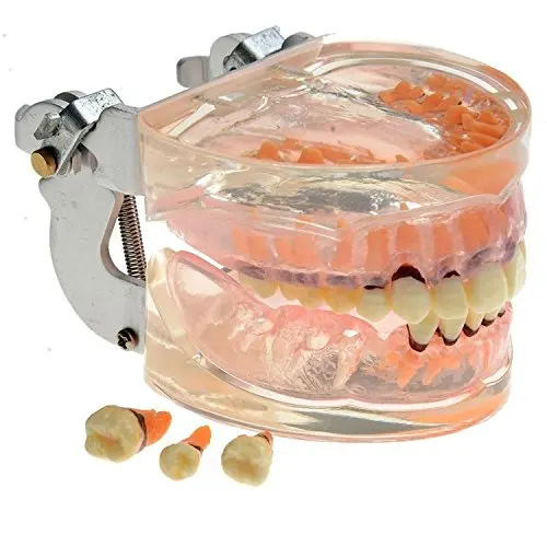 Пародонтоз образовательная модель для обучения для учения зубов зуб зубы анатомическая модель стоматология одонтология