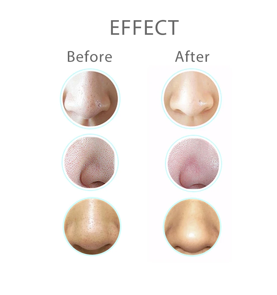 Electric Blackhead Remover (11)