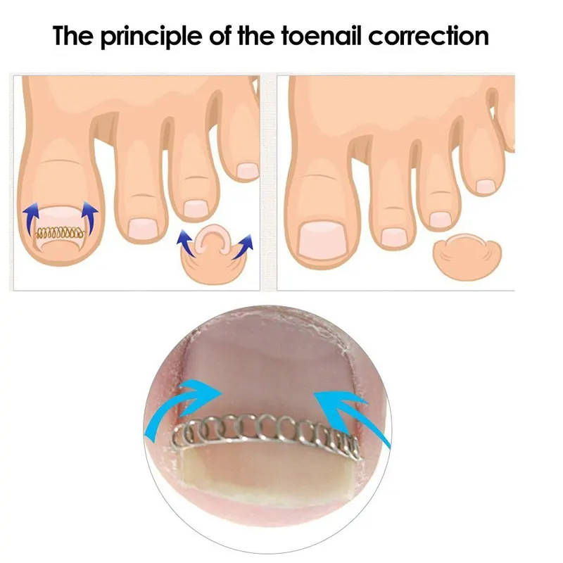 12 шт./компл. вросший носок проволочный фиксатор для коррекции ногтей Педикюр Paronychia восстановление ногтей Корректор