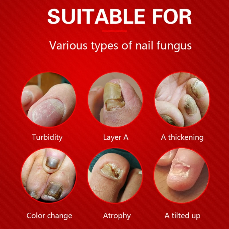 Травяной крем против грибков для восстановления ногтей, крем для лечения грибка пальцев ног, защитный крем для ухода за кожей