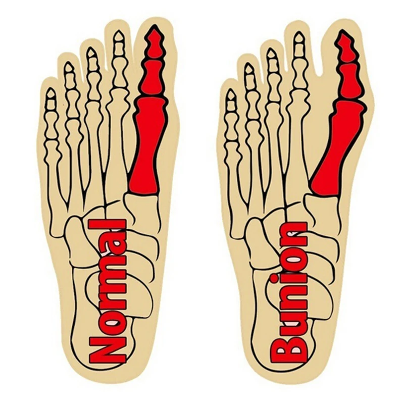 

1 Pair Great Toe Cyst Foot Care Tool Stretch Nylon Hallux Valgus Guard Cushion Bunion Toes Separator Thumb Protector DC88