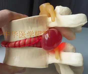 

Lumbar spine enlargement lumbar disc herniation model human spine Vertebral pathology demonstration model
