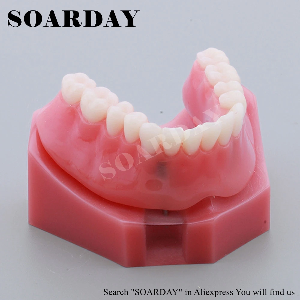 Restoration Implant Model Oral Teaching Demonstration Dentist