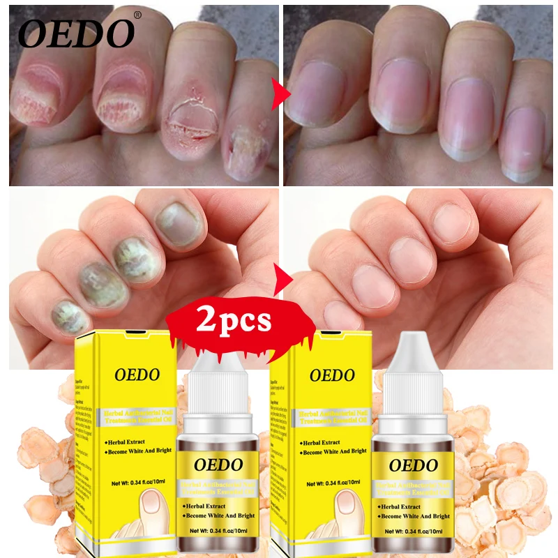 

2pcs/lot antibacterial nail treatment essential oil plant extract nail fungus repair tool foot nail care to improve infection