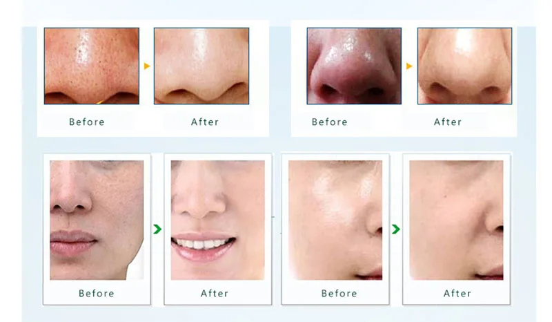 face washing blackhead remover skin cleanser machine 2