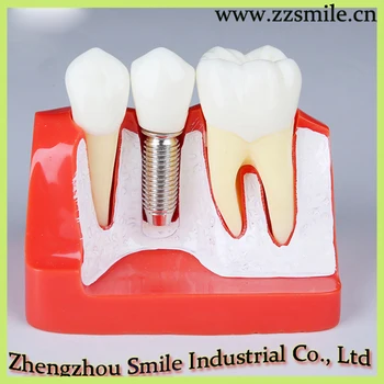 

Dental Implant Model for Doctor-patient communication Use/Dental Implant Analysis Crown Bridge Demonstration Teeth Model M2017R